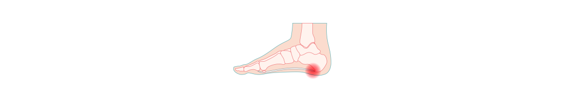 Fascitis plantar