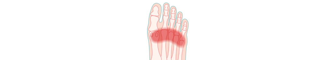 Metatarsal pain