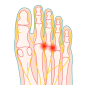 Neuroma di Morton